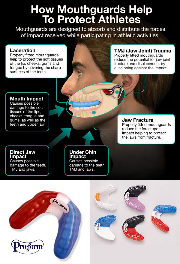 How to Keep Mouth Guards Clean